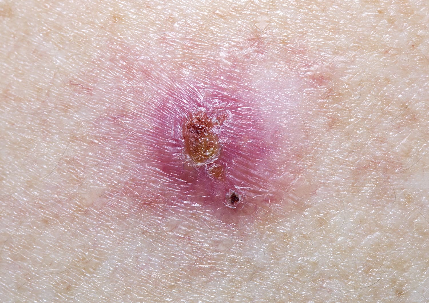 Basal Cell Carcinoma