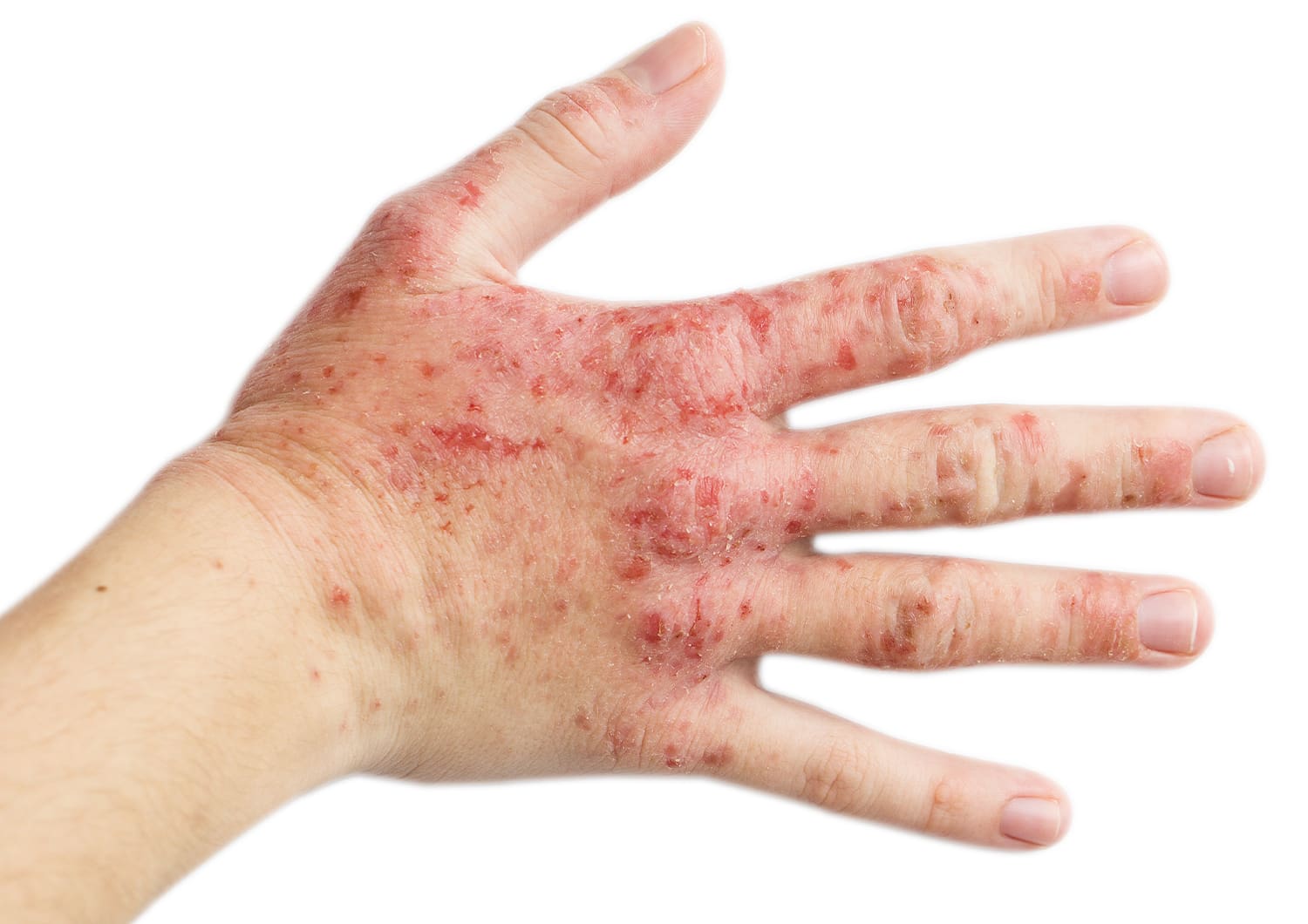 Eczema & Dermatitis