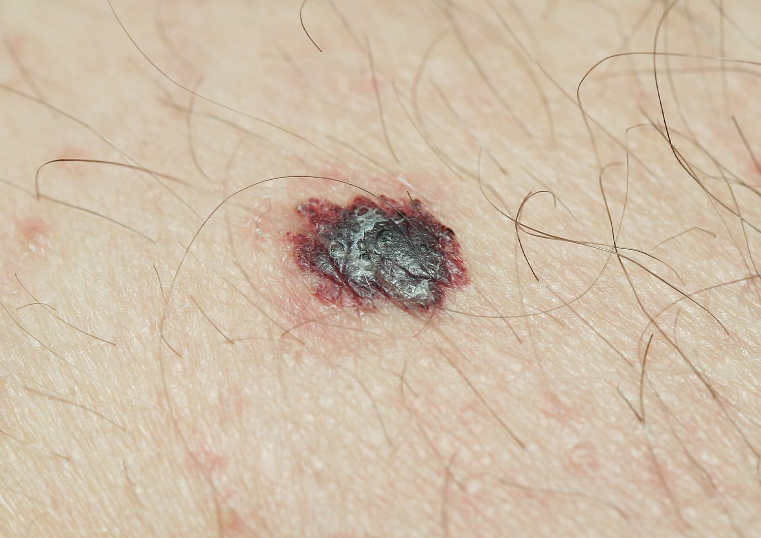 Skin Cancers