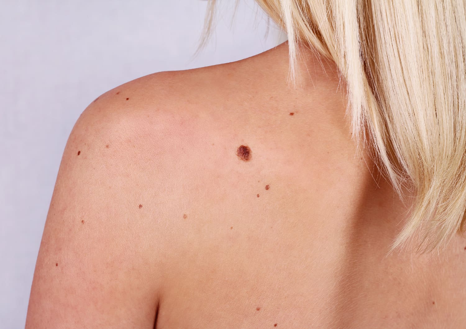 Atypical moles