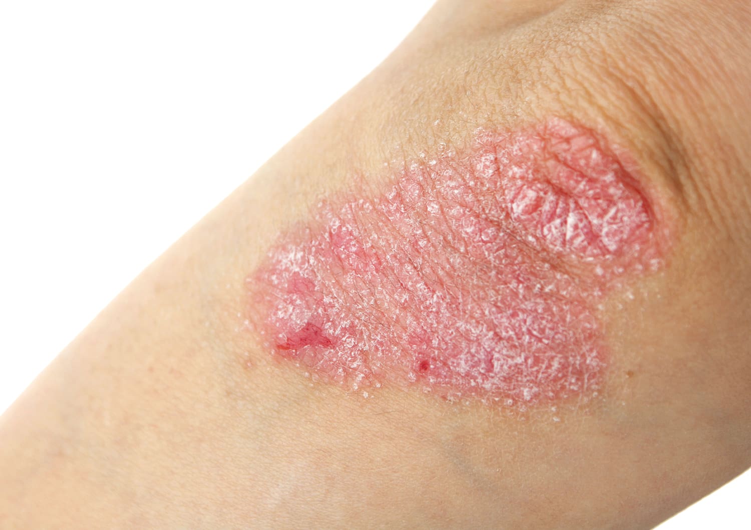 Psoriasis