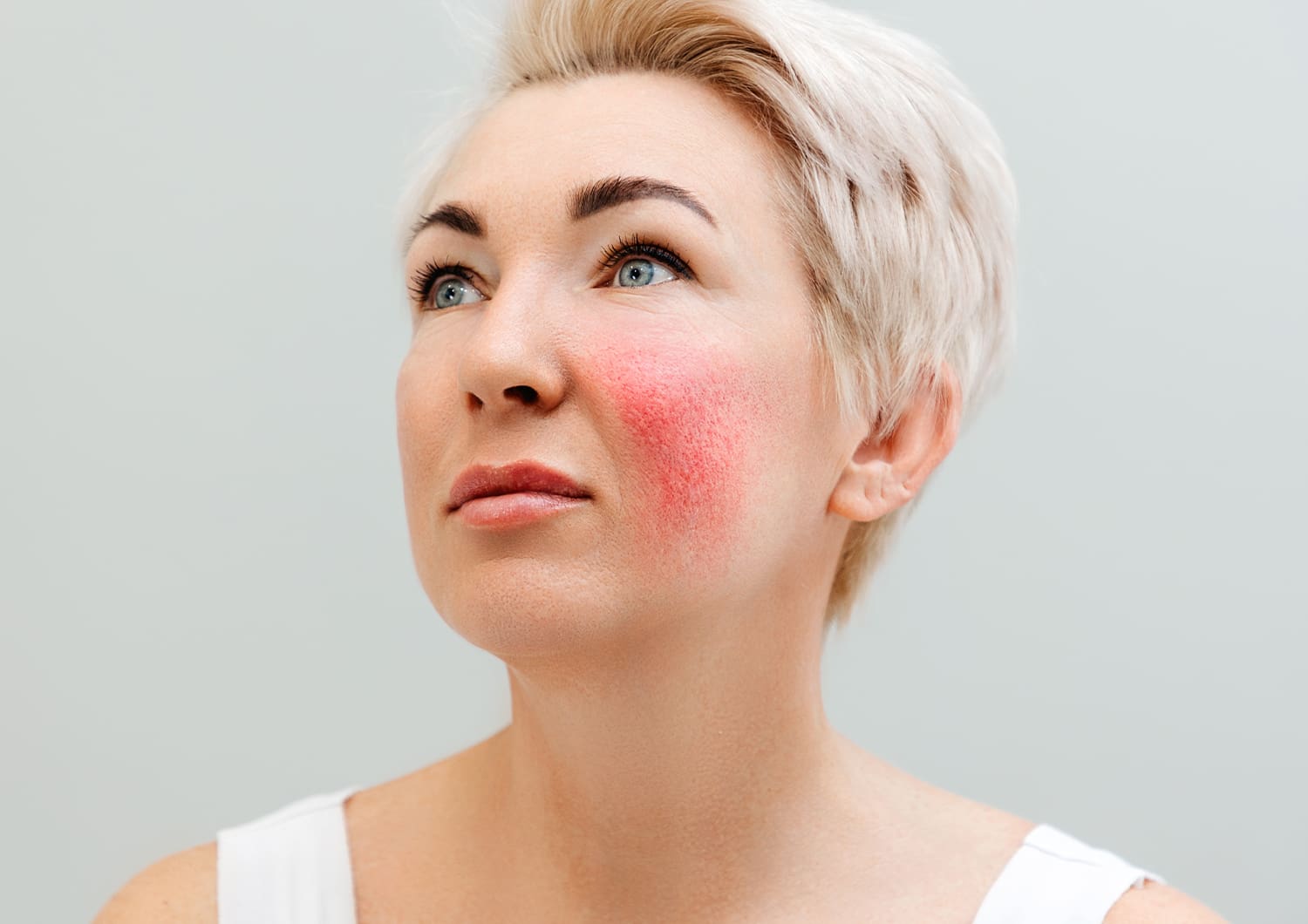 Rosacea & Redness