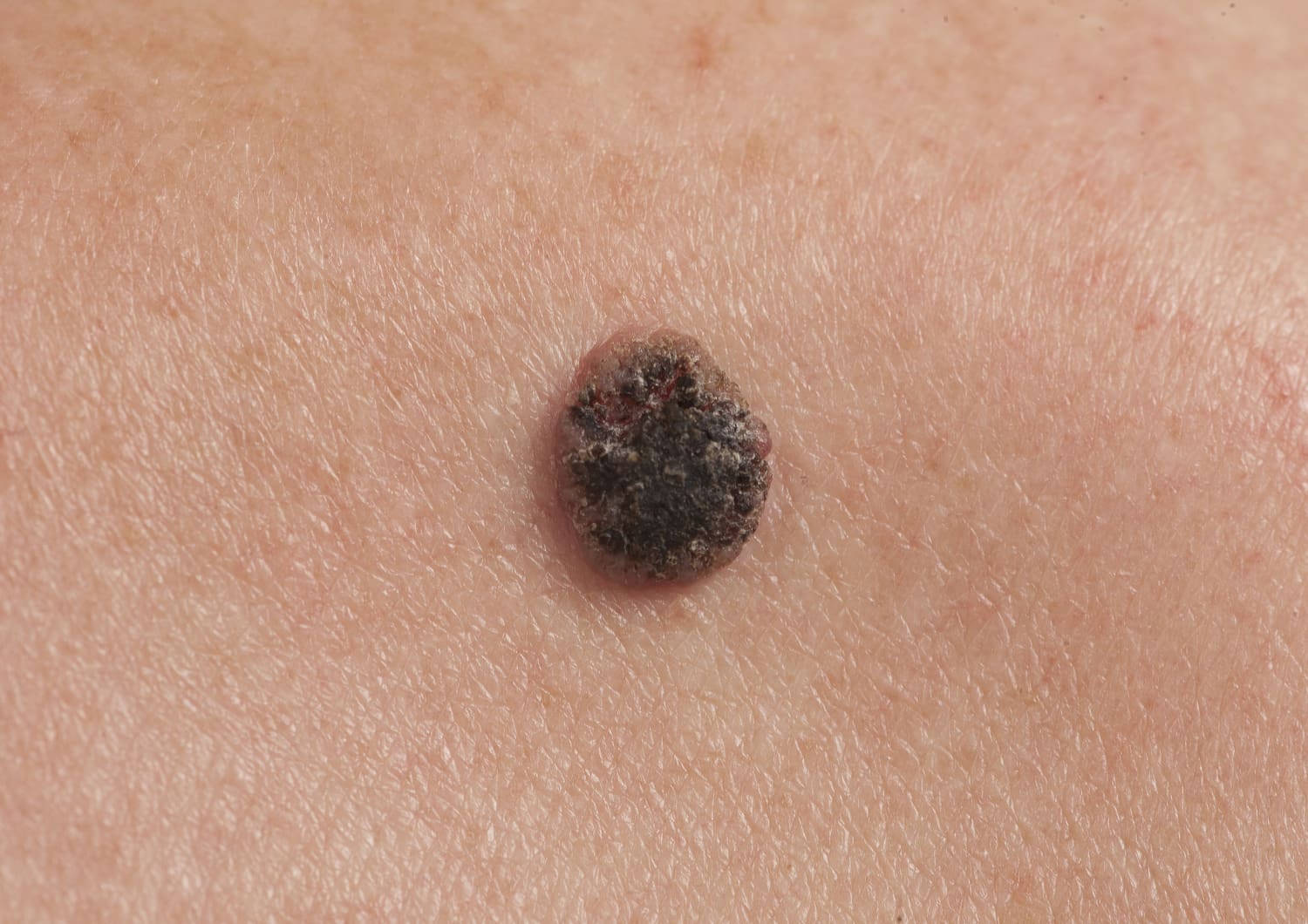 Squamous Cell Carcinoma